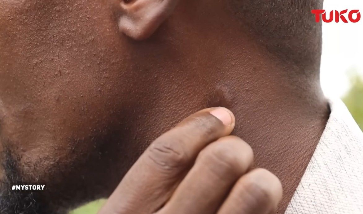 shrapnel in Samewell's neck.jpg