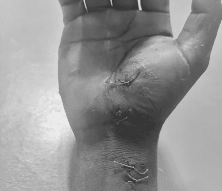 simon's hand wounded.png